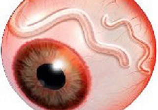 Dibujo donde puede verle una variedad de Oncocercosis que ataca a la vista