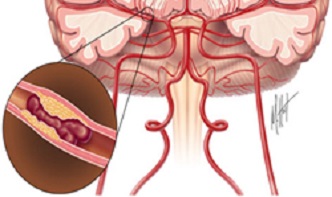 Dibujo de un cerebro y el punto exacto en que se ha producido el ictus
