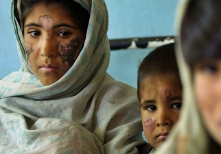 Niños que sufren la enfermedad de la leishmaniasis