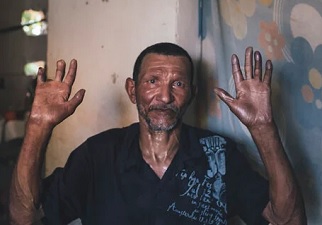 Una persona que sufre la enfermedad de la Lepra