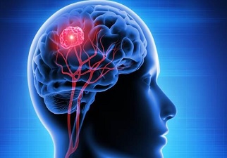 Representación gráfica de una persona con un tumor cerebral