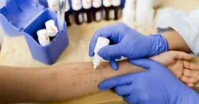 Médico haciendo pruebas alergicas