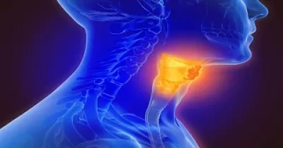 Ilustración 3D de cáncer de garganta